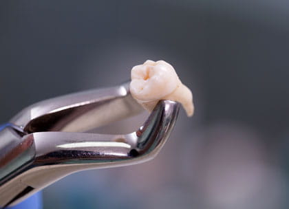 Molar tooth in forceps